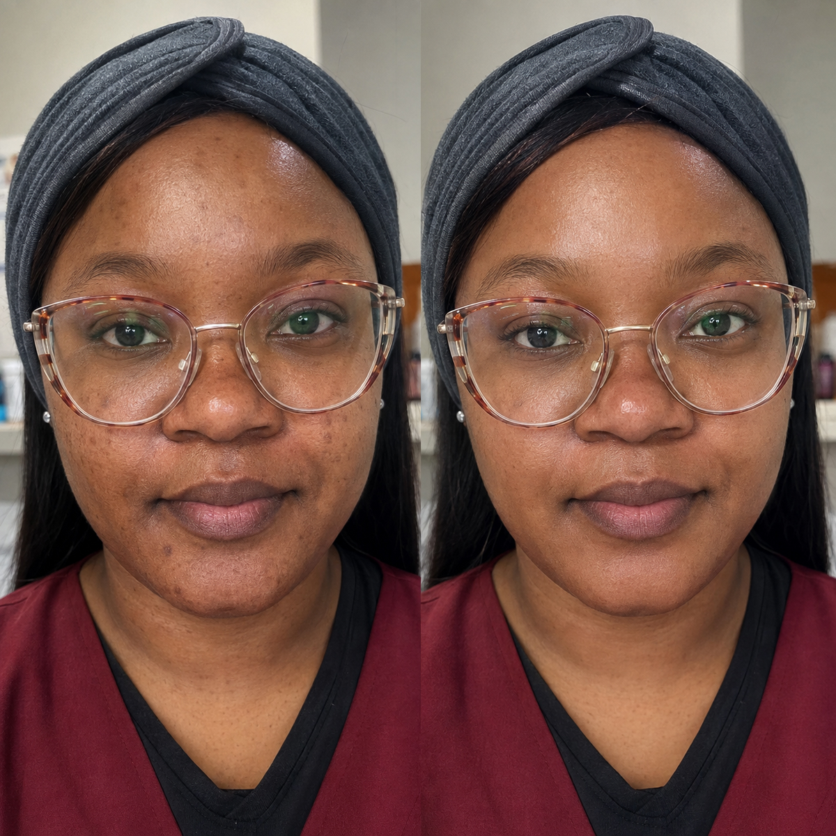 How-To-Get-Rid-of-Forehead-Lines-and-Wrinkles.png